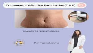 Imagem demonstrando a técnica de permeabilização dérmica para reduzir estrias apresentada no curso Tratamento Definitivo para Estrias