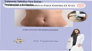 Tratamento Definitivo Para Estrias de Tayna de Lucena Silva – reclamações, avaliações e reputação